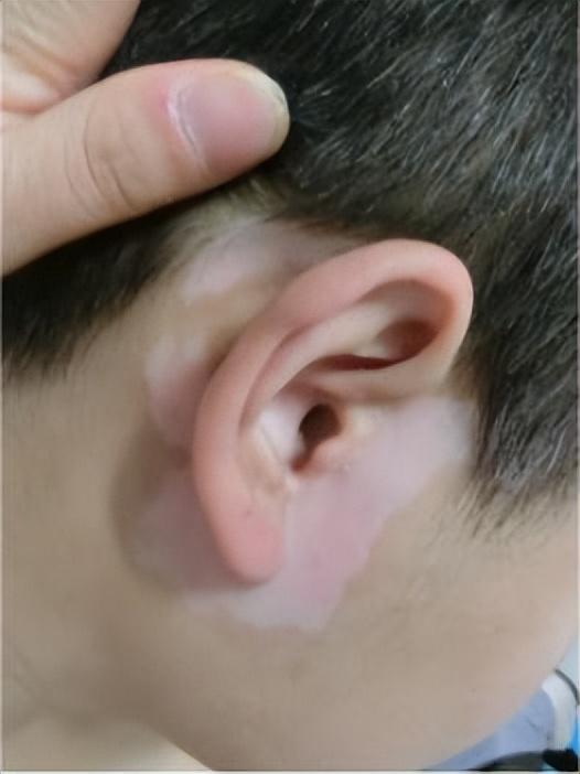 白癜風(fēng)最新治療方法研究與應(yīng)用進(jìn)展